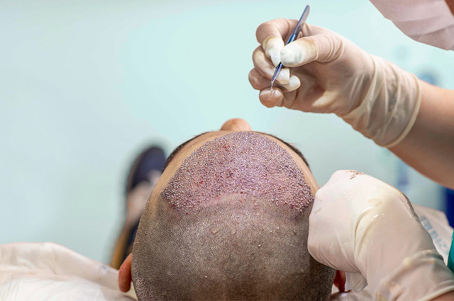 Hair Transplantation